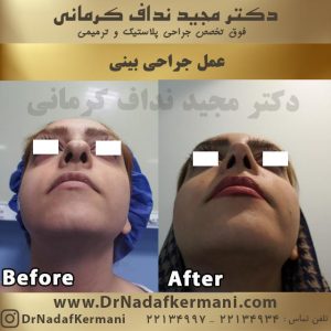 جراحی بینی استخوانی