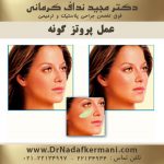 عمل پروتز گونه