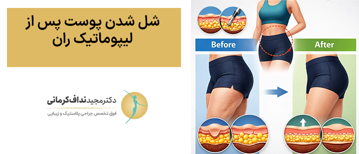 شل شدن پوست بعد از لیپوماتیک ران