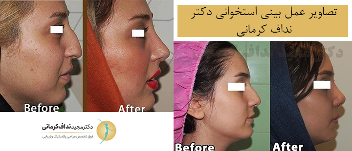 تصاویر عمل بینی استخوانی دکتر نداف