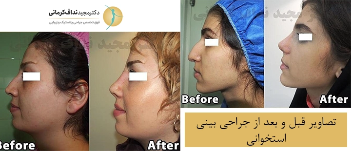 تصاویر قبل و بعد از عمل بینی