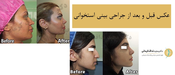 عکس قبل و بعد از جراحی بینی استخوانی