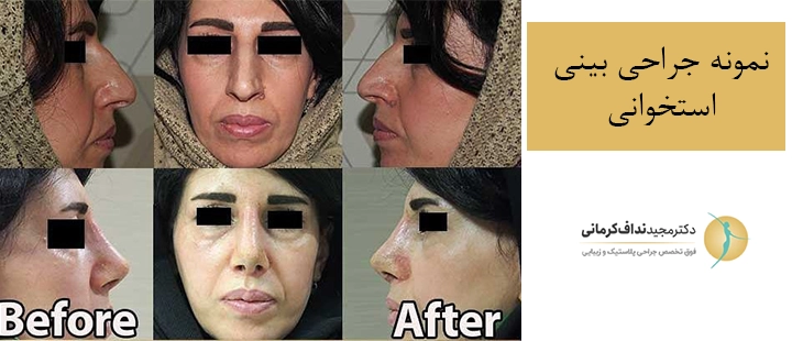 نمونه جراحی بینی استخوانی