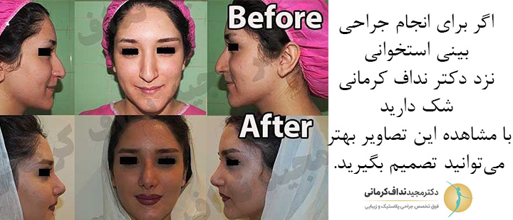 نمونه جراحی بینی استخوانی