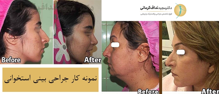 نمونه کار جراحی بینی استخوانی
