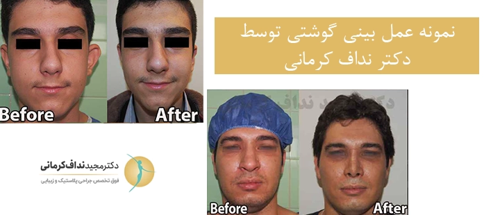 نمونه عمل بینی گوشتی دکتر نداف کرمانی