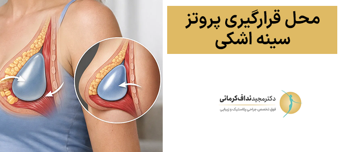 محل قرارگیری پروتز سینه اشکیمحل قرارگیری پروتز سینه اشکی