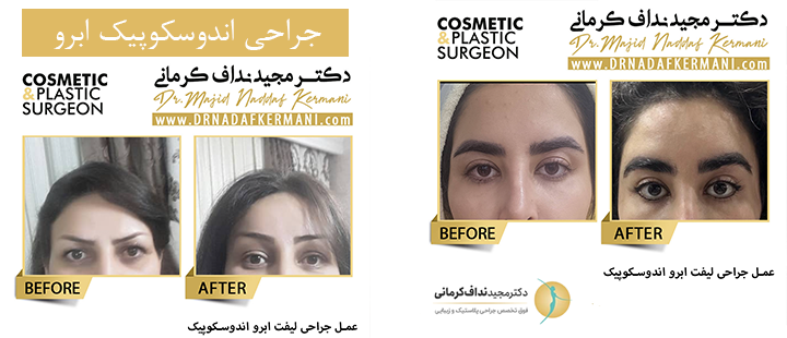 جراحی اندوسکوپیک ابرو دکتر نداف