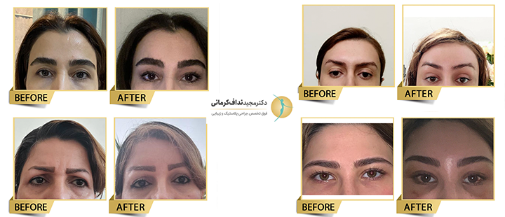 جراحی اندوسکوپیک ابرو توسط دکتر کرمانی