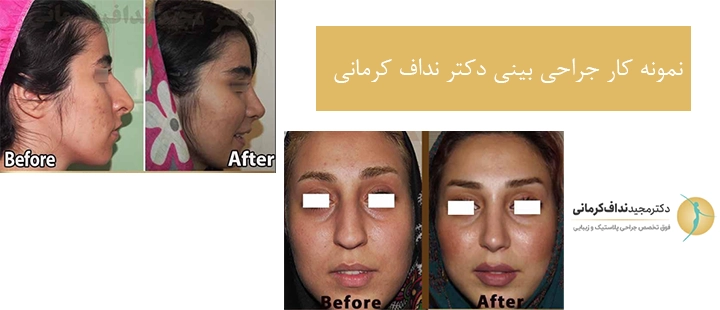 نمونه کار جراحی بینی