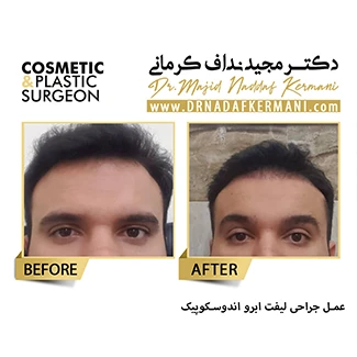 نمونه جراحی لیفت ابرو 1