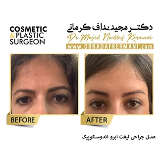نمونه جراحی لیفت ابرو 2
