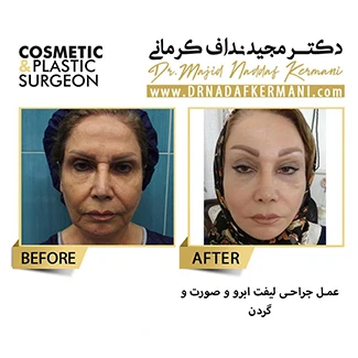 نمونه جراحی لیفت صورت 1