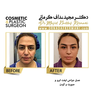 نمونه جراحی لیفت صورت 15