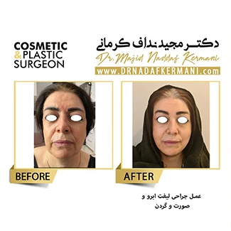 نمونه جراحی لیفت صورت 16
