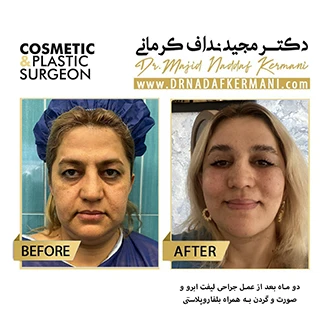 نمونه جراحی لیفت صورت 21