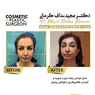 نمونه جراحی لیفت صورت 22