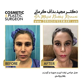 نمونه جراحی لیفت صورت 23