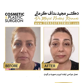 نمونه جراحی لیفت صورت 24