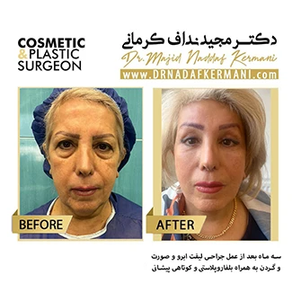 نمونه جراحی لیفت صورت 7