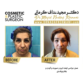 نمونه جراحی لیفت صورت 8