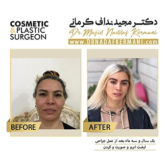 نمونه جراحی لیفت صورت 2