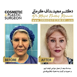 نمونه جراحی لیفت صورت 25