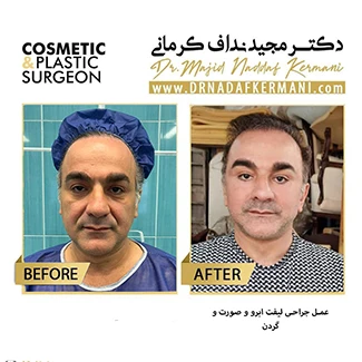 نمونه جراحی لیفت صورت 26