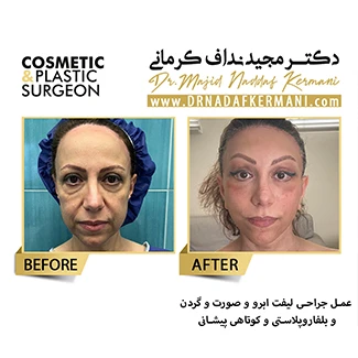 نمونه جراحی لیفت صورت 19