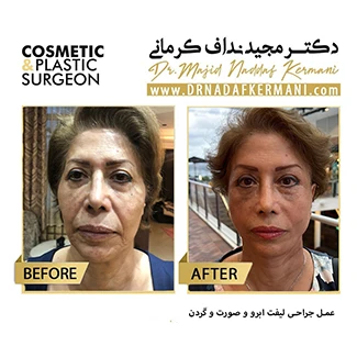 نمونه جراحی لیفت صورت 20
