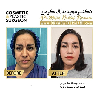 نمونه جراحی لیفت صورت17