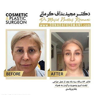 نمونه جراحی لیفت صورت 3