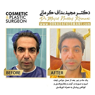 نمونه جراحی لیفت صورت 4
