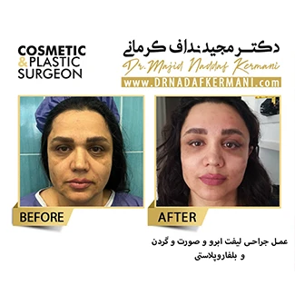 نمونه جراحی لیفت صورت 5
