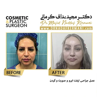 نمونه جراحی لیفت صورت 6