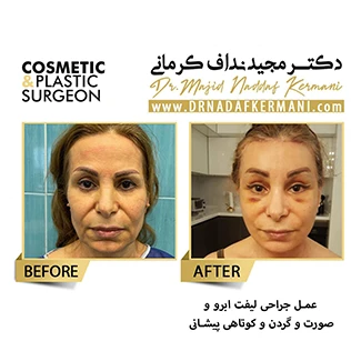 نمونه جراحی لیفت صورت 9