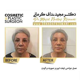 نمونه جراحی لیفت صورت 10
