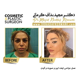 نمونه جراحی لیفت صورت 11