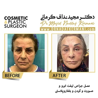 نمونه جراحی لیفت صورت 12