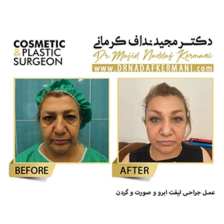 نمونه جراحی لیفت صورت 13