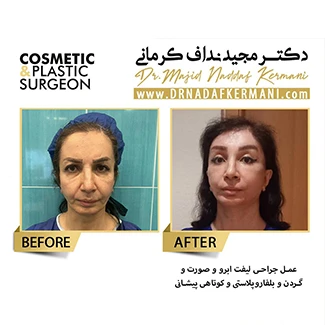 نمونه جراحی لیفت پیشانی 2