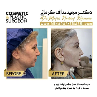 نمونه جراحی لیفت گردن 1