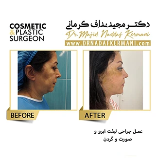 نمونه جراحی لیفت گردن 2