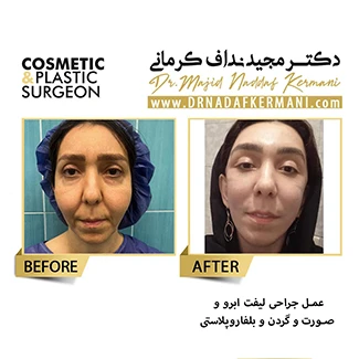 نمونه جراحی پلک 1