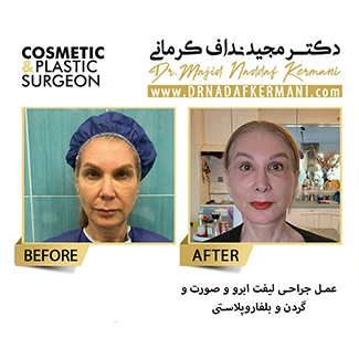 نمونه جراحی پلک 2