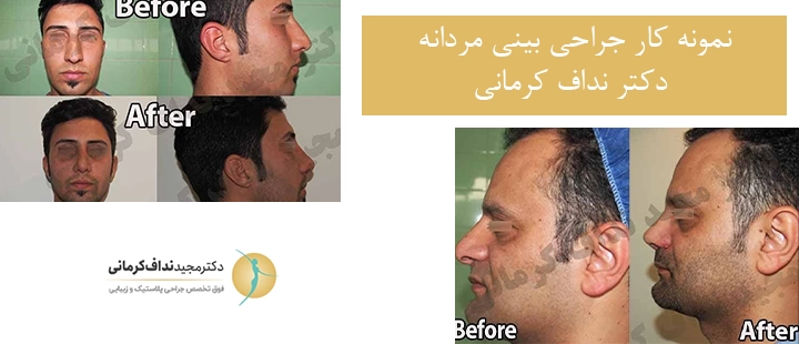 نمونه کار جراحی بینی مردانه دکتر نداف کرمانی