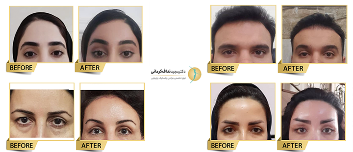 لیفت اندوسکوپی ابرو دکتر نداف کرمانی