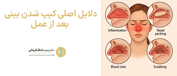 دلایل اصلی کیپ شدن بینی بعد از عمل