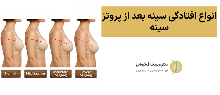 انواع افتادگی سینه بعد از پروتز